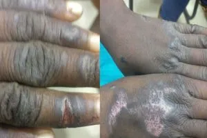 महिला डॉक्टर की हैवानियत : नाबालिग को कैंची से काटा और फिर प्रेस जलाया