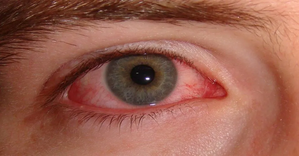 Redness Of Eyes
